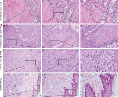 Tissue mechanics modulate PCNP expression in oral squamous cell carcinomas with different differentiation